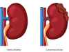 Normal Kidney VS Cancerous Kidney